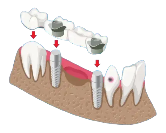 Implant Supported Dentures
